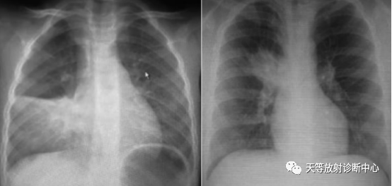 肺炎支原体肺炎-3