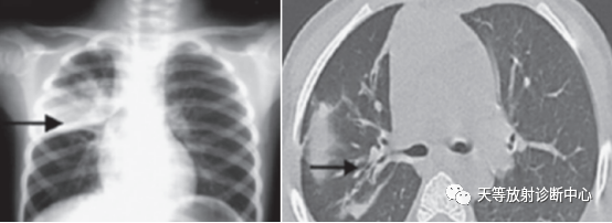 肺炎支原体肺炎-2
