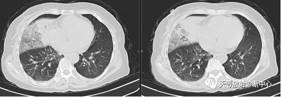 肺炎支原体肺炎-5