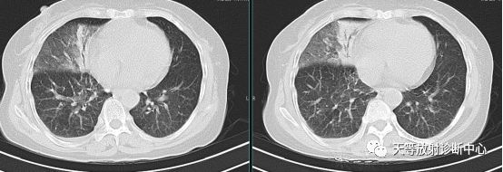 肺炎支原体肺炎-6