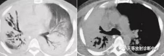 肺炎支原体肺炎-7