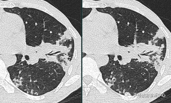 肺炎支原体肺炎-8