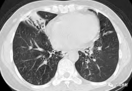 非结核分枝杆菌( NTM)-5