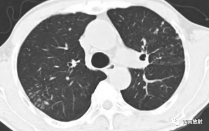 非结核分枝杆菌( NTM)-3