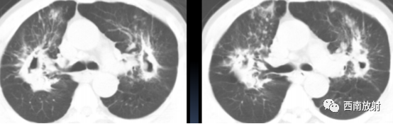 非结核分枝杆菌( NTM)-4