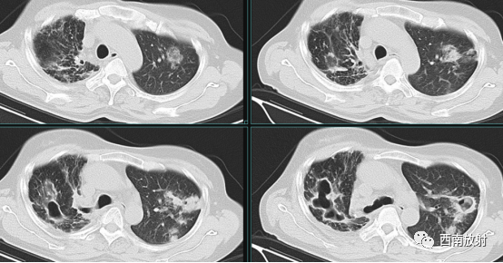 非结核分枝杆菌( NTM)-9