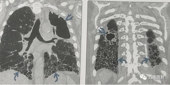 非结核分枝杆菌( NTM)-11