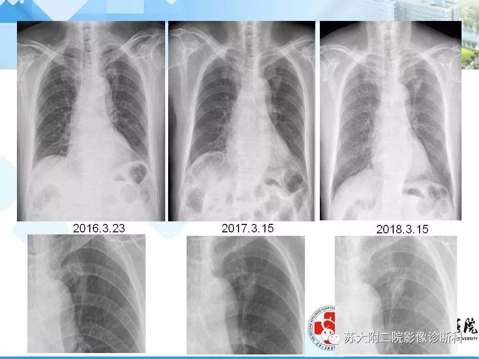 【PPT】胸部X线平片的漏诊陷阱-3