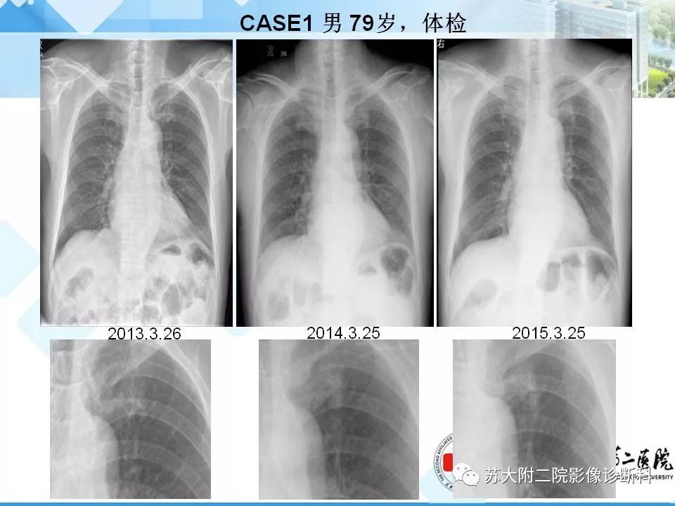 【PPT】胸部X线平片的漏诊陷阱-2