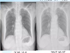 胸部X线平片的漏诊陷阱