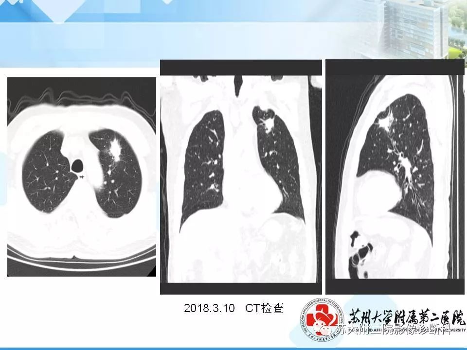 【PPT】胸部X线平片的漏诊陷阱-4