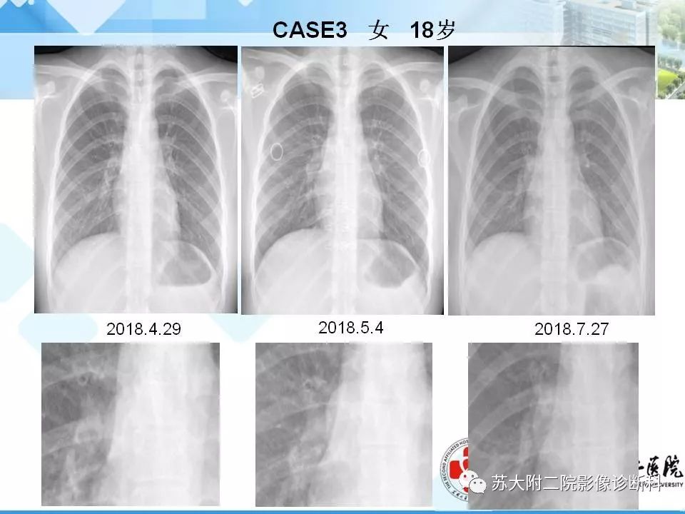 【PPT】胸部X线平片的漏诊陷阱-6