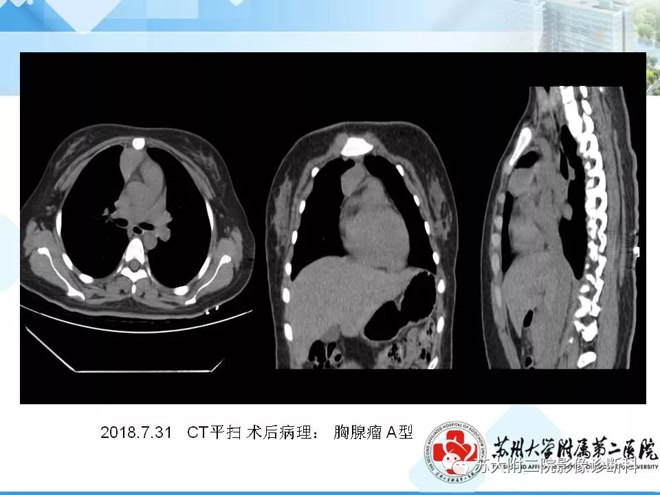 【PPT】胸部X线平片的漏诊陷阱-7