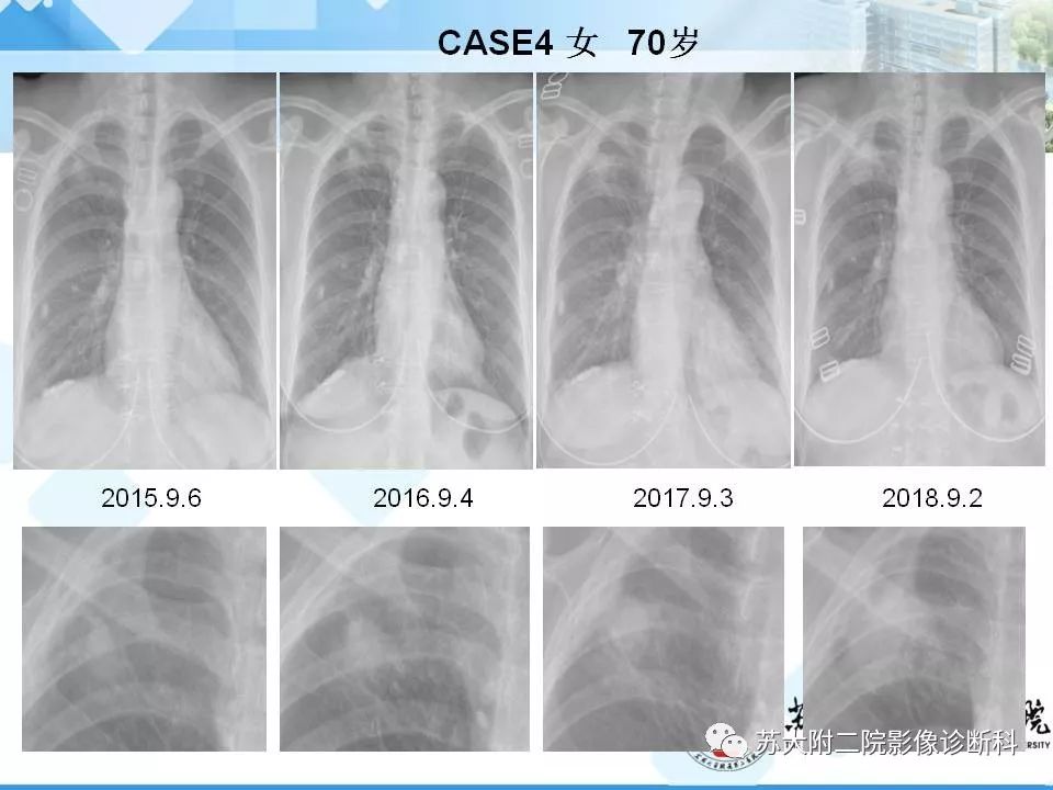【PPT】胸部X线平片的漏诊陷阱-8