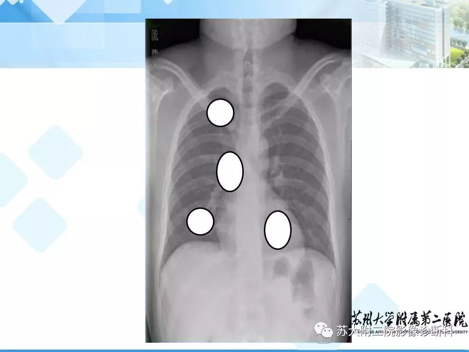 【PPT】胸部X线平片的漏诊陷阱-11