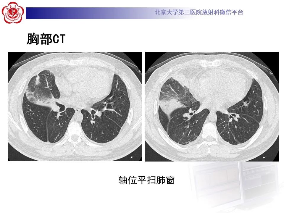 【PPT】嗜酸性肉芽肿性多血管炎-5