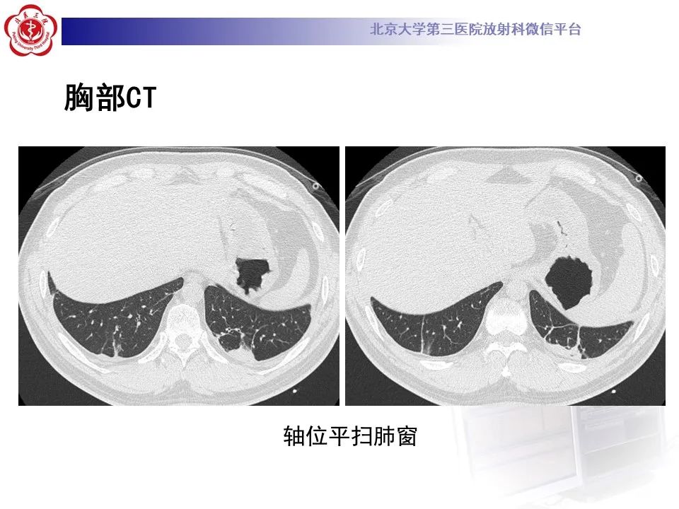 【PPT】嗜酸性肉芽肿性多血管炎-6