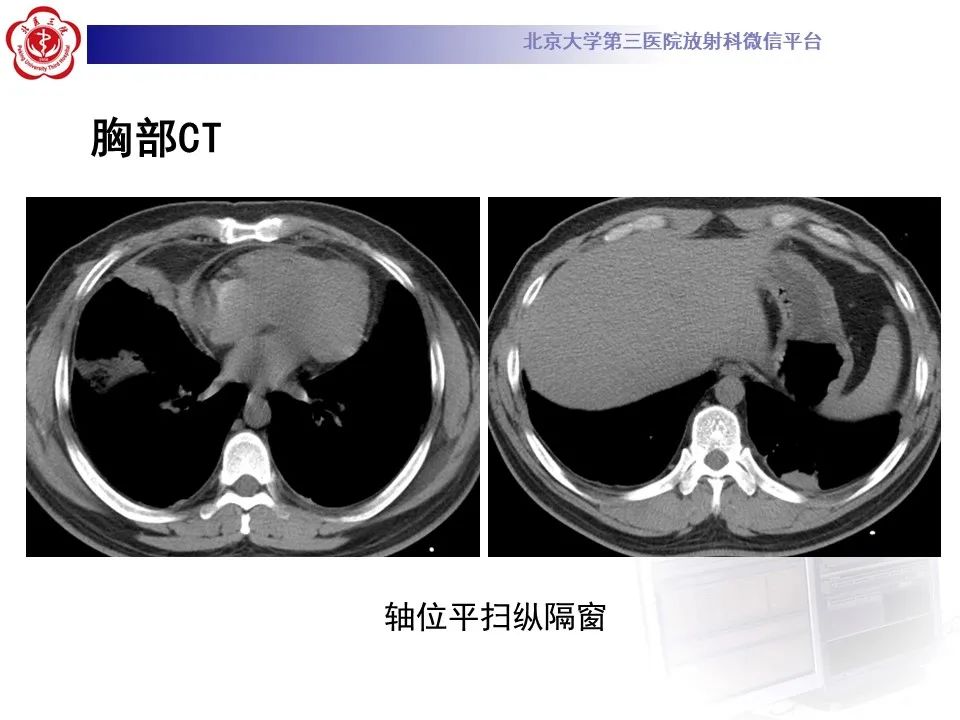 【PPT】嗜酸性肉芽肿性多血管炎-7