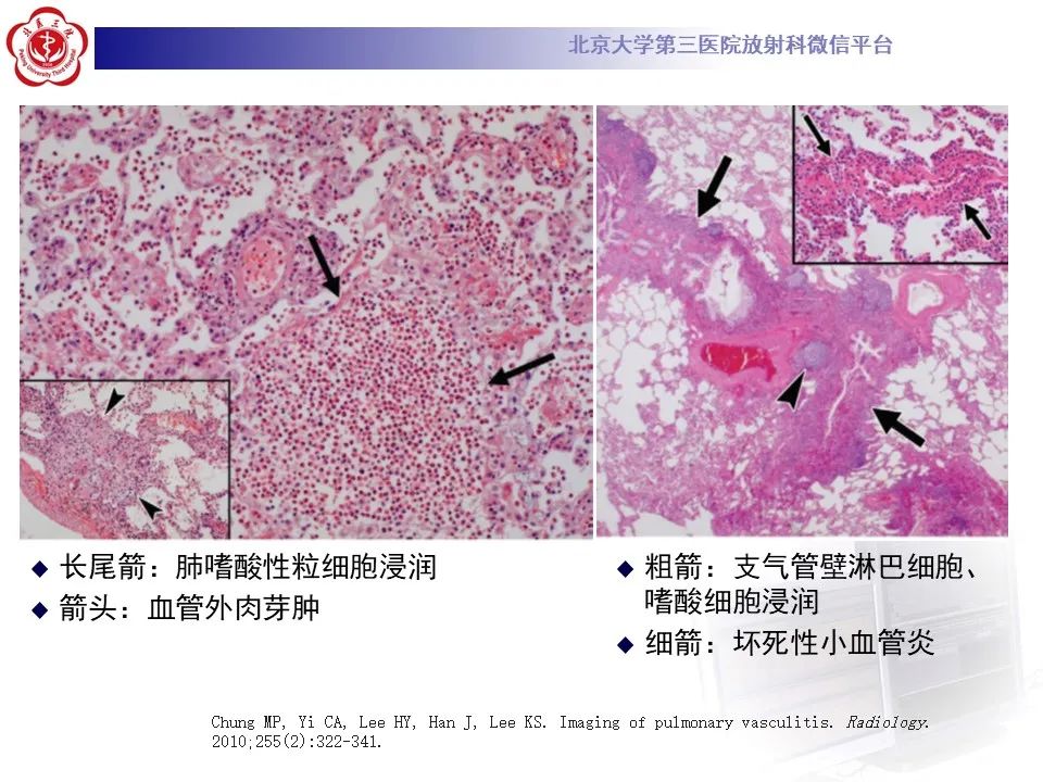 【PPT】嗜酸性肉芽肿性多血管炎-22