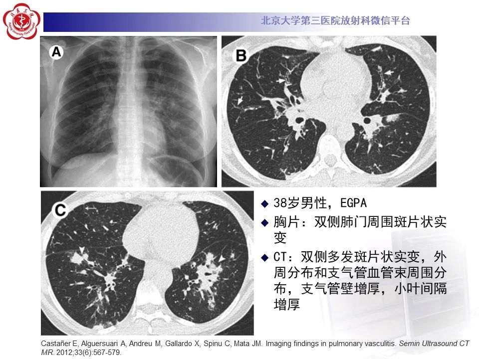 【PPT】嗜酸性肉芽肿性多血管炎-27