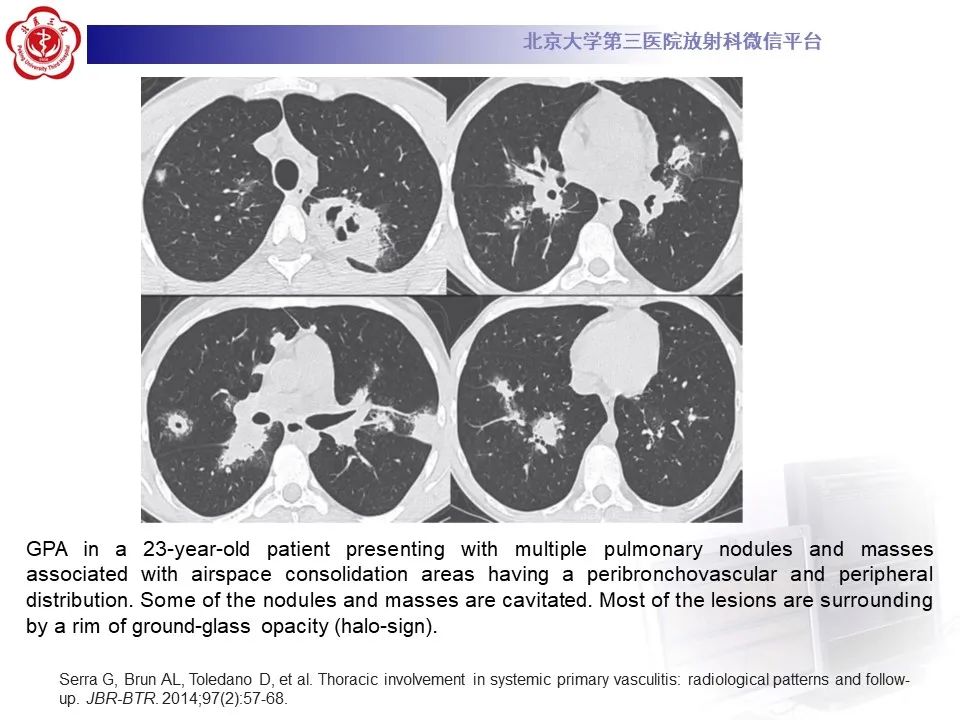 【PPT】嗜酸性肉芽肿性多血管炎-31