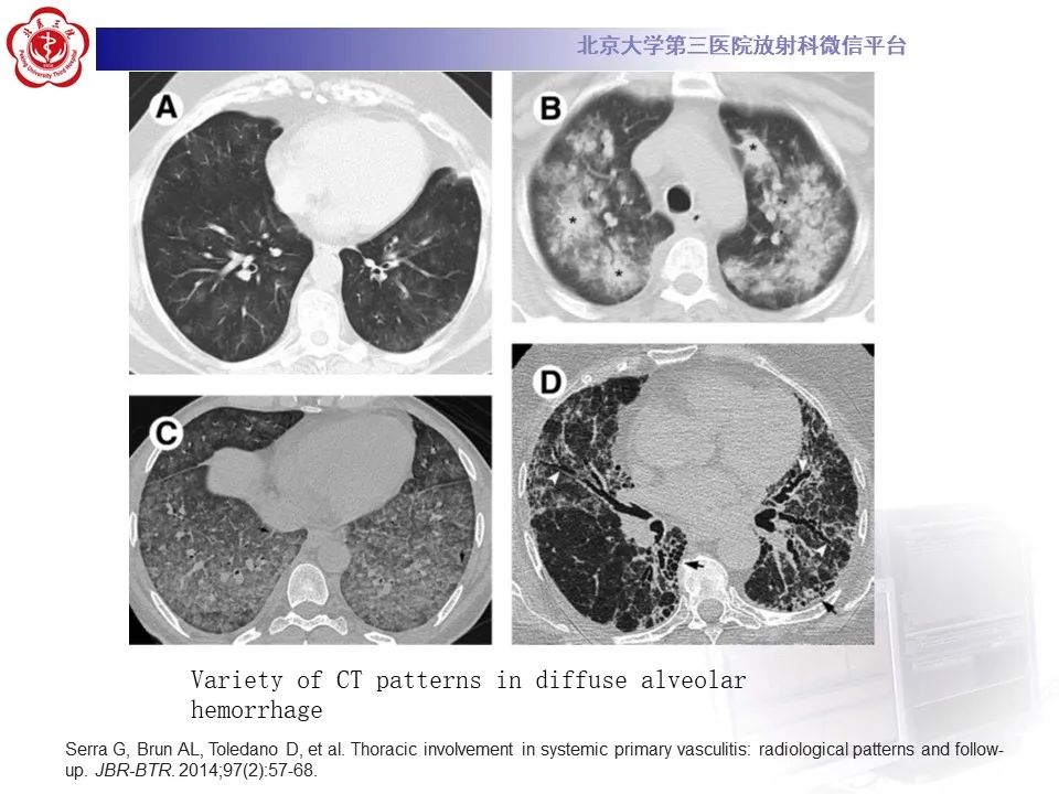 【PPT】嗜酸性肉芽肿性多血管炎-32
