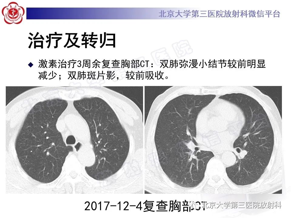 【PPT】过敏性肺炎-10