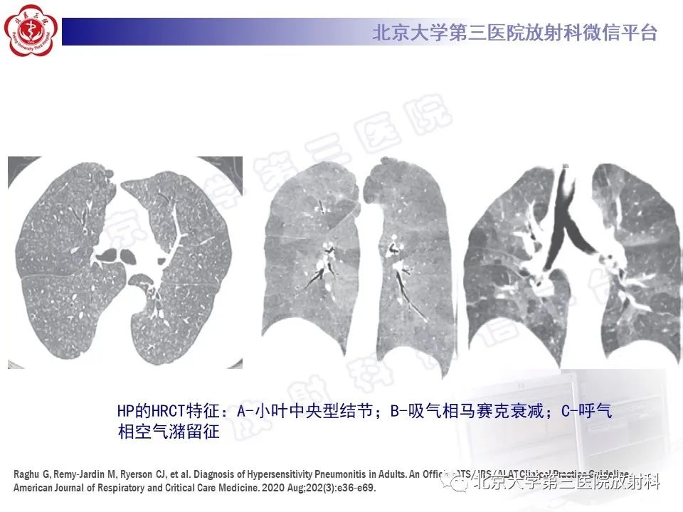 【PPT】过敏性肺炎-18