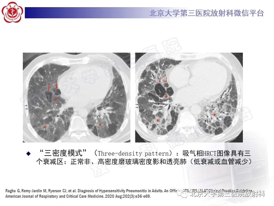 【PPT】过敏性肺炎-19