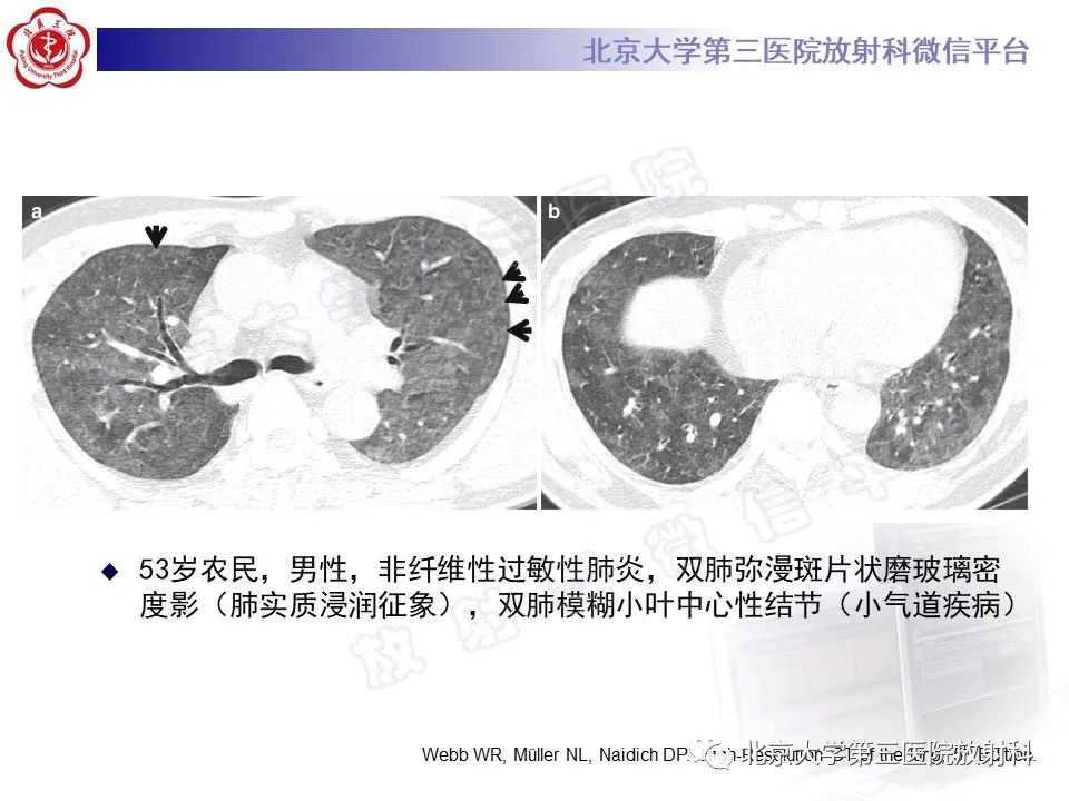 【PPT】过敏性肺炎-20