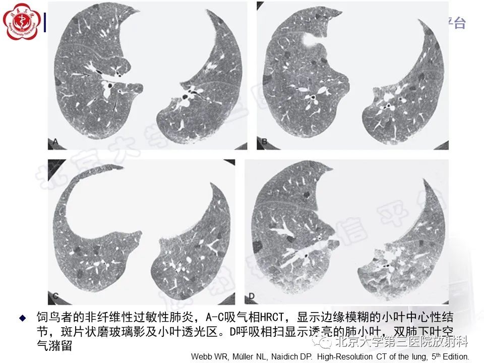 【PPT】过敏性肺炎-22