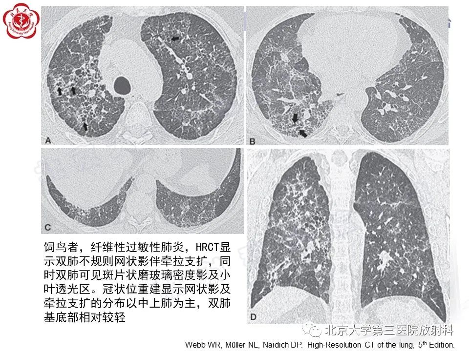 【PPT】过敏性肺炎-25