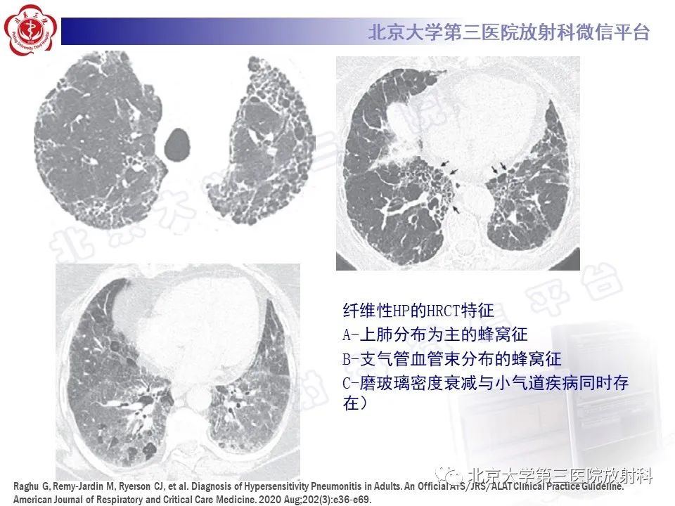 【PPT】过敏性肺炎-24