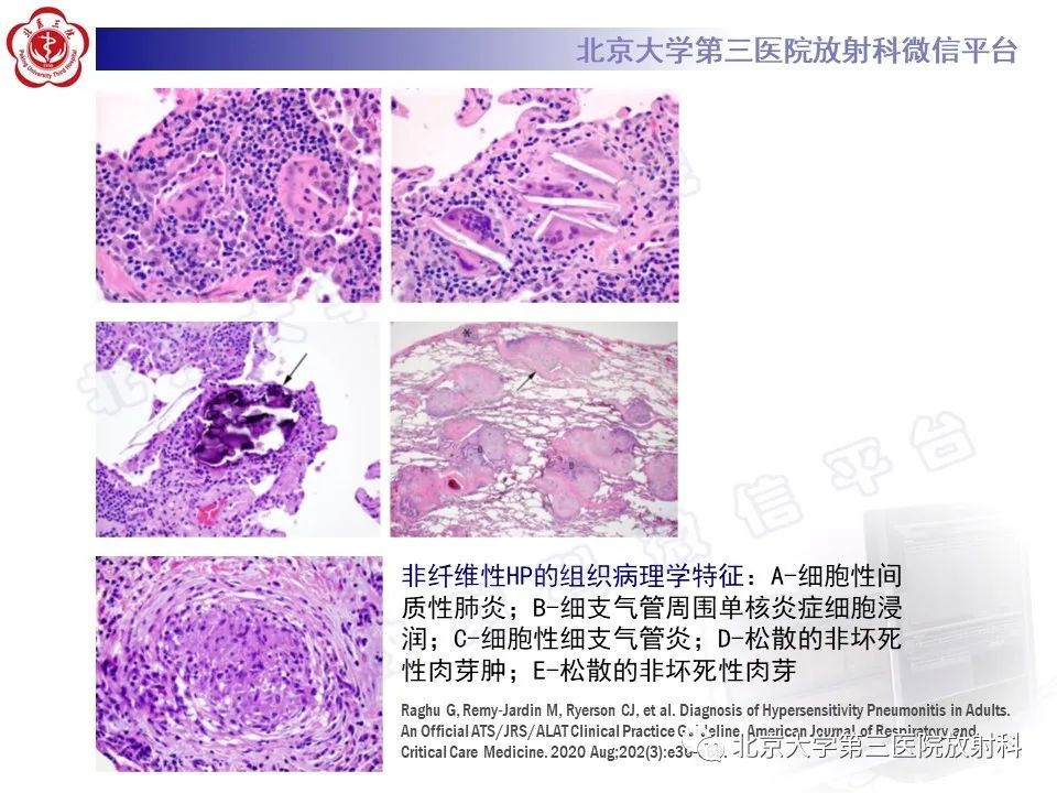 【PPT】过敏性肺炎-28
