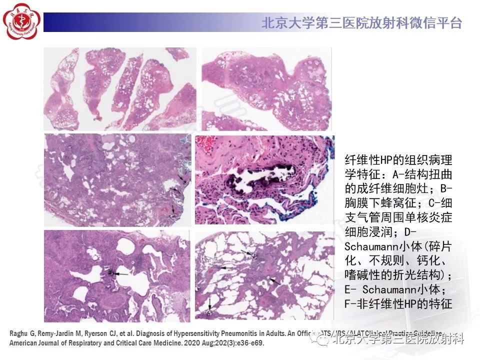 【PPT】过敏性肺炎-30