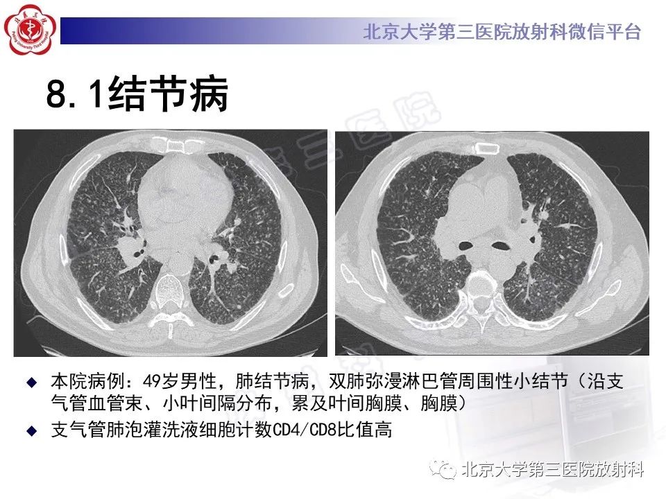 【PPT】过敏性肺炎-34