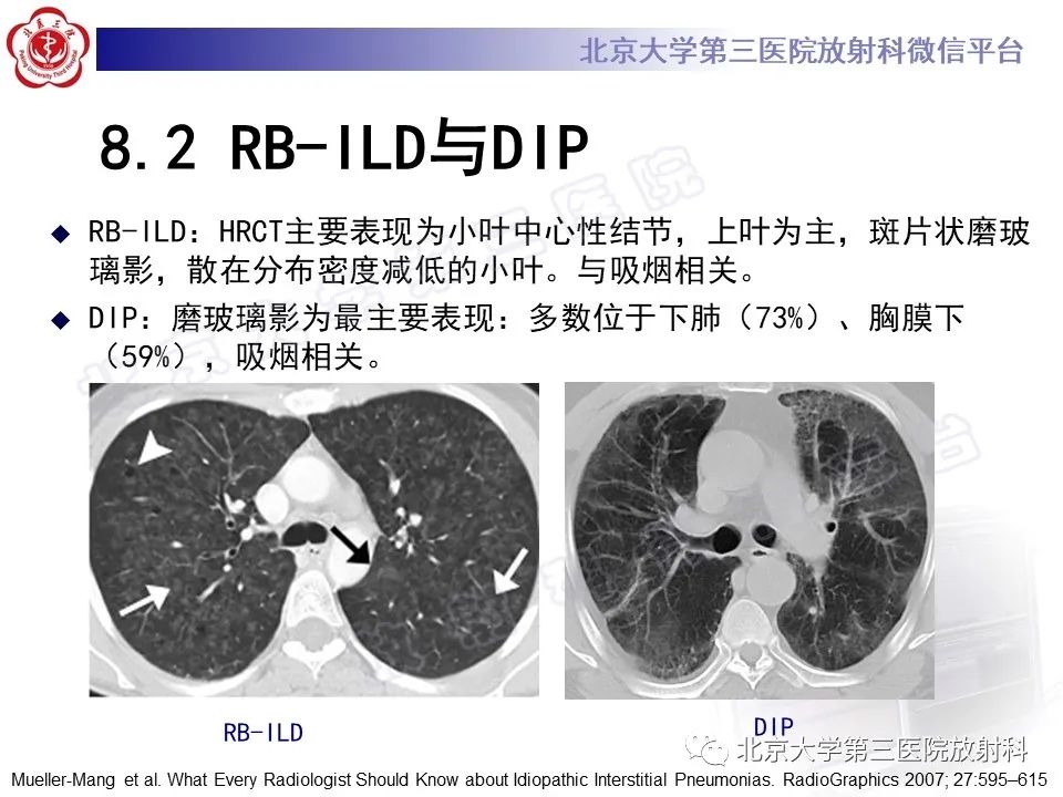 【PPT】过敏性肺炎-35