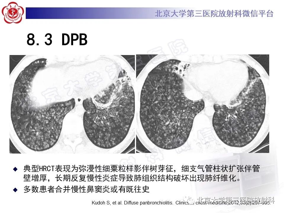 【PPT】过敏性肺炎-36