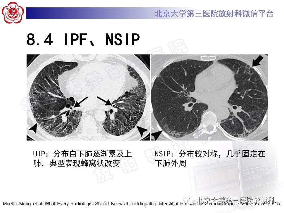 【PPT】过敏性肺炎-37