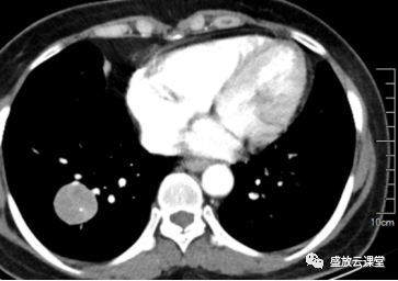 【病例】右肺下叶硬化性肺细胞瘤1例CT影像-4