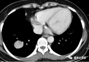 【病例】右肺下叶硬化性肺细胞瘤1例CT影像-3