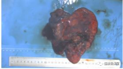 【病例】右肺下叶硬化性肺细胞瘤1例CT影像-5