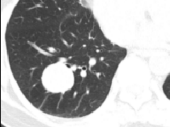 右肺下叶硬化性肺细胞瘤1例CT影像