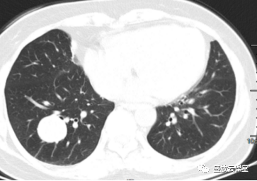 【病例】右肺下叶硬化性肺细胞瘤1例CT影像-1