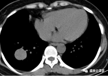 【病例】右肺下叶硬化性肺细胞瘤1例CT影像-2