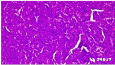 【病例】右肺下叶硬化性肺细胞瘤1例CT影像-6