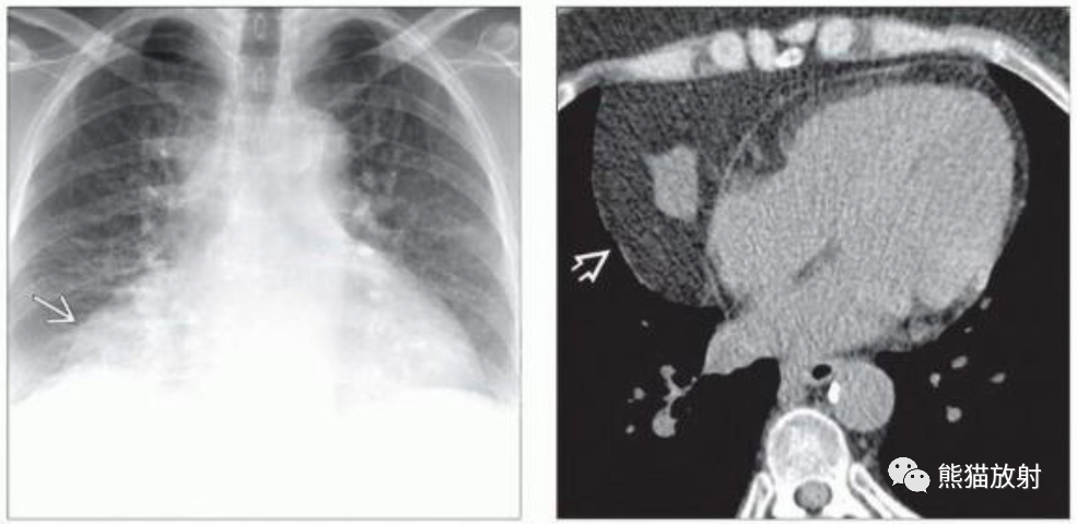 胸腺脂肪瘤、纵隔畸胎瘤影像表现-2