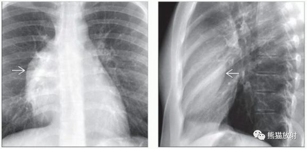 胸腺脂肪瘤、纵隔畸胎瘤影像表现-3