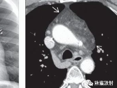 胸腺脂肪瘤、纵隔畸胎瘤影像表现
