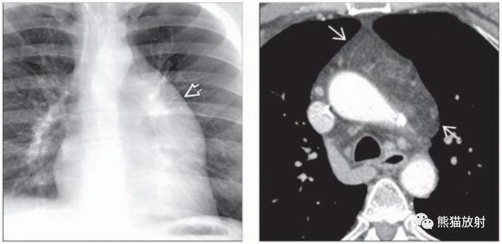 胸腺脂肪瘤、纵隔畸胎瘤影像表现-1